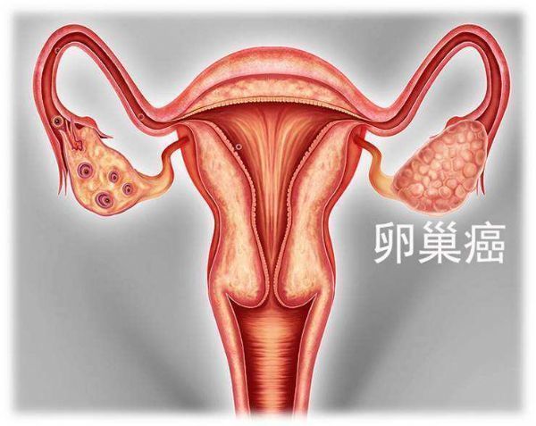 尼拉帕尼(NIRAPARIB)对卵巢癌有什么样的效果?